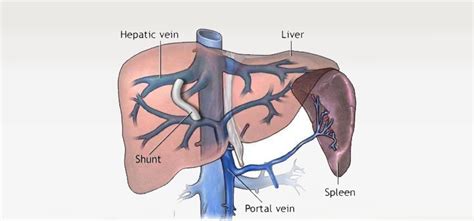 Transjugular Intrahepatic Portosystemic Shunt (TIPS) - IRCC Pakistan