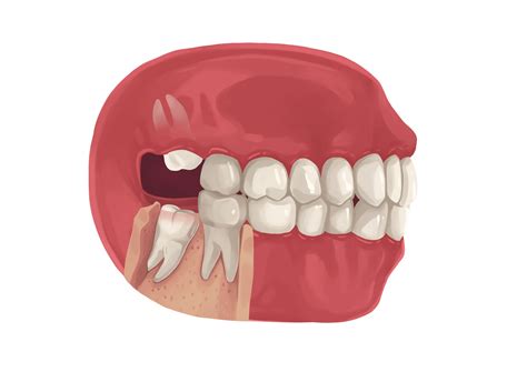 How to manage a broken wisdom tooth? Causes, risks, and treatment