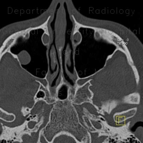 Radiology case: Cyst of maxillary sinus