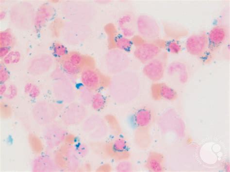 Ringed sideroblasts (iron stain)