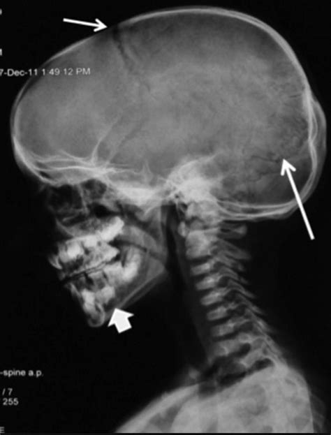 Cleidocranial Dysplasia (Dysostosis) - Pediatrics - Orthobullets