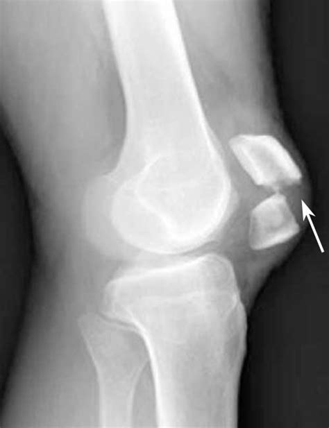 Patellar Fractures (Broken Kneecap) - OrthoInfo - AAOS