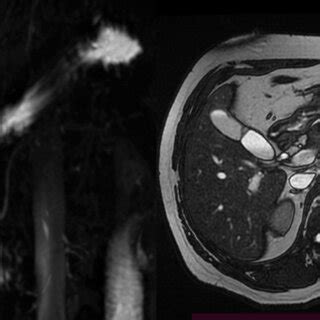 (PDF) Septate gallbladder: A rare congenital anomaly