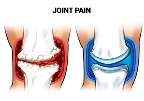 Joint Pain Treatment NYC | Best Joint Specialists in Midtown & UES