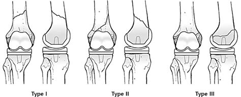 Anteroposterior and lateral views of periprosthetic distal femoral ...