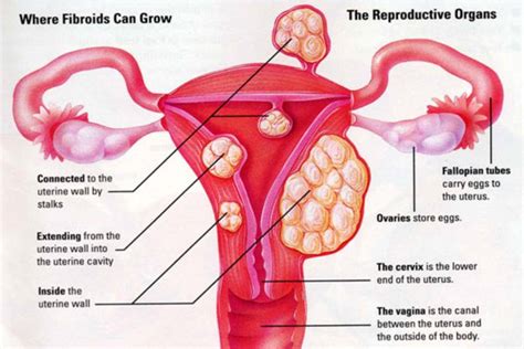 Cure Fibroid In 60 Days Without Surgery... 100% Guaranteed!: Do You Know Why There Is A High ...