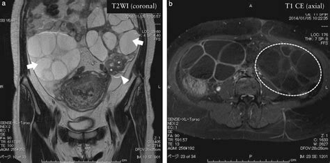 Theca Luteum Cyst