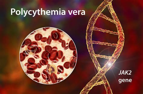 Polycythemia vera and the Links to Radon and Radium (Pennsylvania Case ...