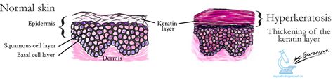 What Characterizes Retention Hyperkeratosis