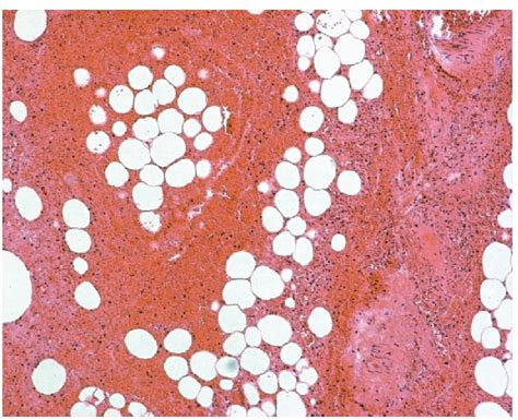 Histology of the strangulated omentum showing subtotal haemorrhagic... | Download Scientific Diagram