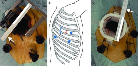 Skin incision and port placement. (A) Photograph of the axillary... | Download Scientific Diagram