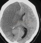 Bamford/Oxford classification of ischemic stroke | STROKE MANUAL