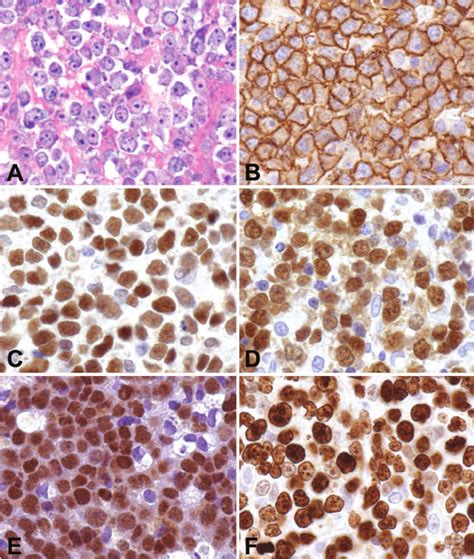 Histopathology and immunohistochemical profile of a typical PCNSL case.... | Download Scientific ...