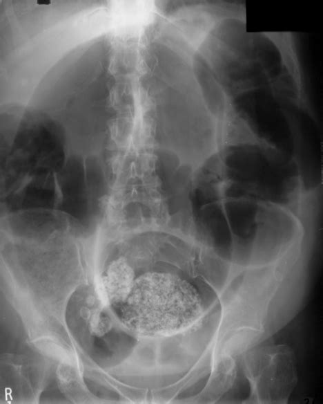 Sigmoid volvulus | Radiology Key