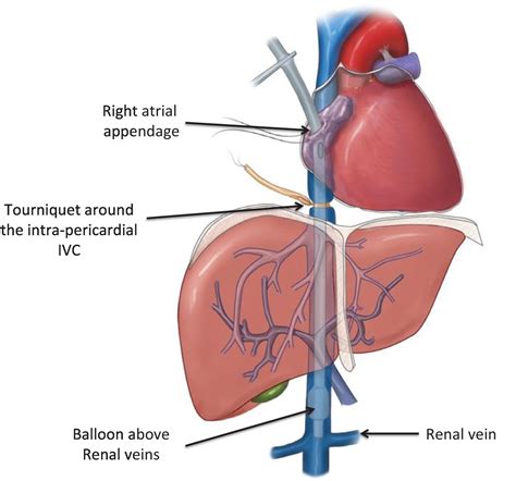 Inferior Vena Cava Anatomy