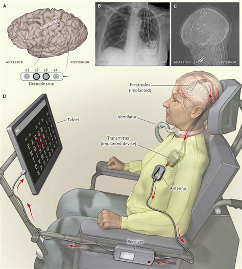 Brain-driven speech computer aids communication of ALS patient