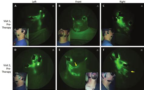 Near-infrared fluorescence lymphatic imaging illustrating case 5's ...