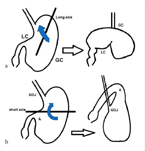 Schematic representation of (a) organo-axial volvulus and (b ...