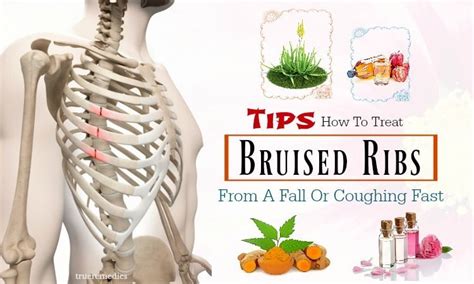 17 Tips How To Treat Bruised Ribs From A Fall Or Coughing Fast