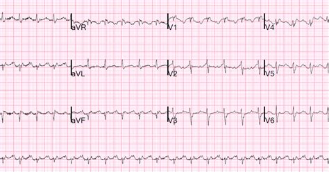 Dr. Smith's ECG Blog: Right sided heart failure and tachycardia.