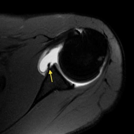 posterior labral tear shoulder mri