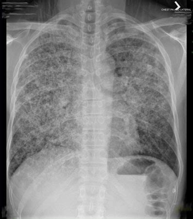 Pneumonia Bacteriana - Pneumonia Bacteriana - O que é, Sintomas e Tratamentos | Dicas de Saúde ...