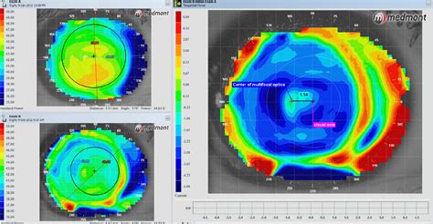 3 Ways to Identify Multifocal Misalignment Issues