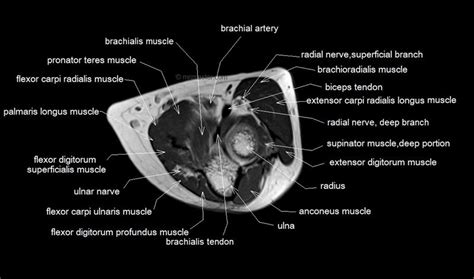 mri anatomy elbow - Google Search | Radiologia