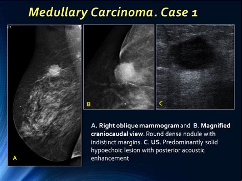 Figure 7 from Well-circumscribed breast carcinoma. Keys to face the ...