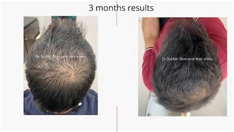 Regrow hair naturally in 3 months: Dermatologist Recommended - Dermatocare