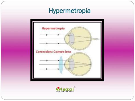 PPT - Hypermetropia: Causes, Symptoms, Daignosis, Prevention and Treatment PowerPoint ...