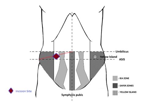 Tenckhoff Catheter Insertion by a Nephrologist - Renal Fellow Network