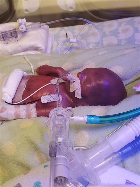 Baby Born at 21 Weeks Defies the Odds, Becomes One of the Youngest Babies to Survive