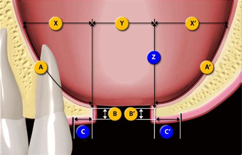 One-stage operation of large oroantral fistula closure, sinus lifting, and autogenous bone ...