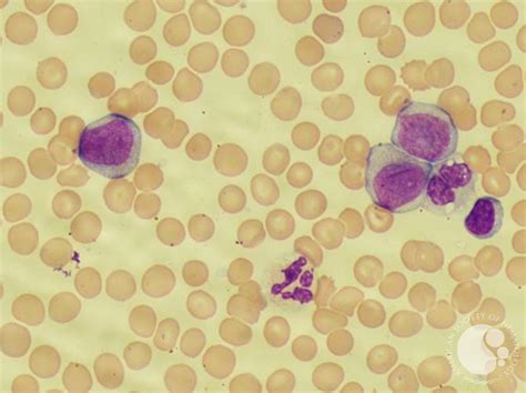 Acute monocytic leukemia 1