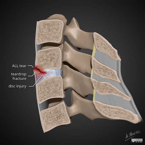 Extension tear drop fracture | Radiology Reference Article | Radiopaedia.org | Radiology ...