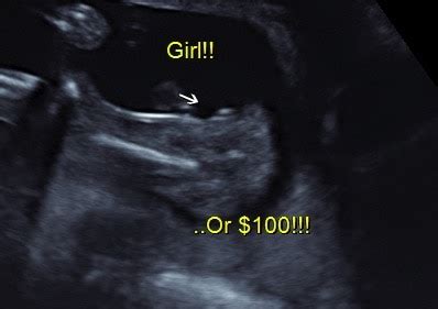 Can ultrasound be wrong about gender - mozswift