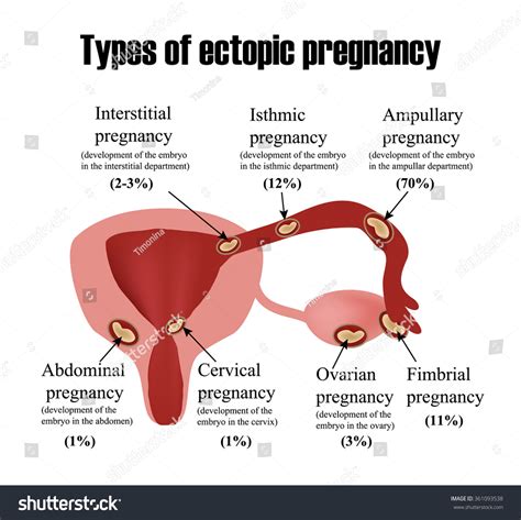 Tipos de embarazo ectópico. Infografía. Ilustración: vector de stock ...