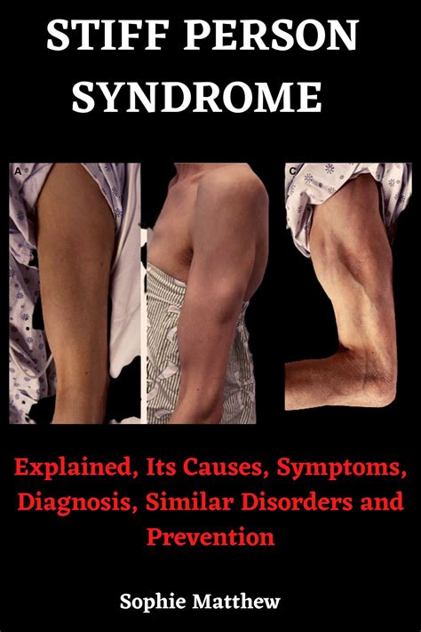 Stiff Person Syndrome Book: Explained, Its Causes, Symptoms, Diagnosis ...