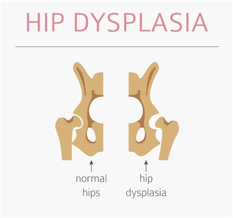 10 Frequently Asked Questions about Hip Dysplasia - Facty Health