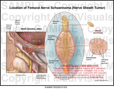 Location of Femoral Nerve Schwannoma (Nerve Sheath Tumor)