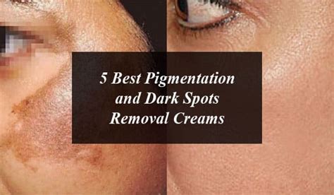 5 Best Pigmentation and Dark Spots Removal Creams in Pakistan