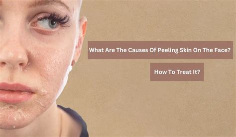 What Are The Causes Of Peeling Skin On The Face? How To Treat It?