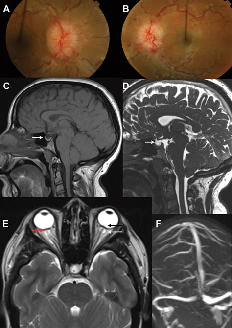 Idiopathic Intracranial Hypertension Mri