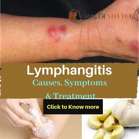 Lymphangitis : Causes, Picture, Symptoms And Treatment