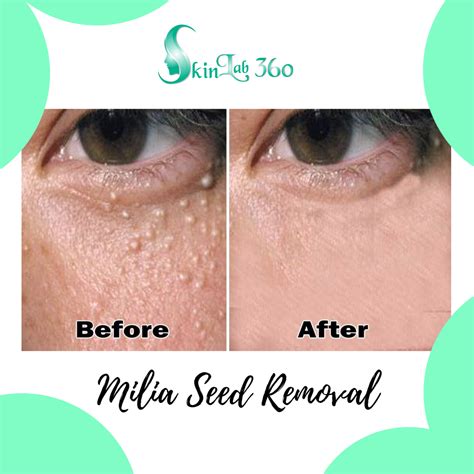 Milia Seed/Skin Tag Removal - Skin Lab 360™