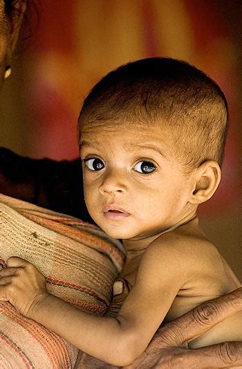 Malnutrition: the state of Children and Women in India - Vskills Blog