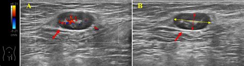 Inguinal Lymph Nodes Diagram