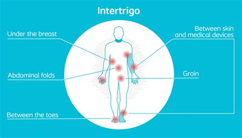 Intertrigo Treatment at Home Through Coloplast InterDry