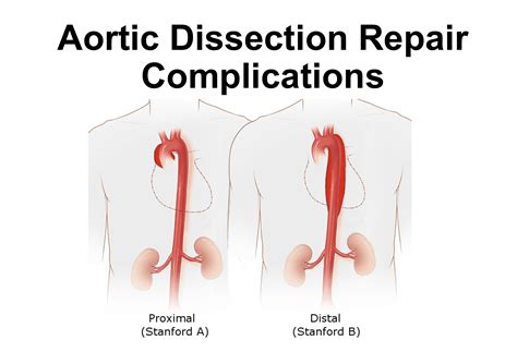 emDOCs.net – Emergency Medicine EducationAortic Dissection Repair Complications: ED ...